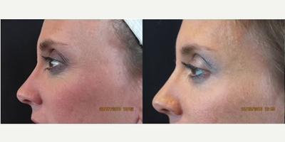 Botox before and after photo