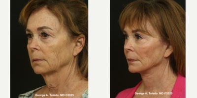 before and after image