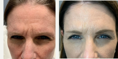 Dysport before and after photo