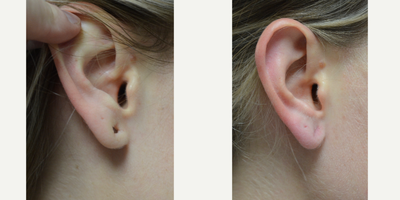 Earlobe Repair before and after photo