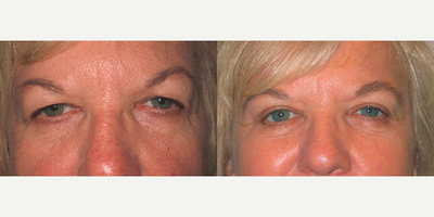 Eyelid Surgery before and after photo