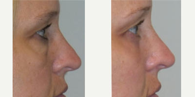 Eyelid Surgery before and after photo