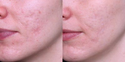 Fraxel Laser before and after photo