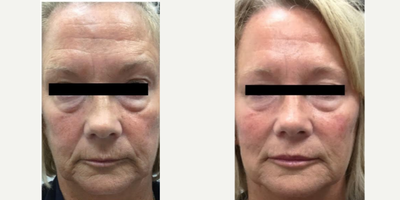 Juvederm before and after photo