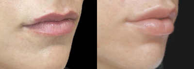 Juvederm before and after photo