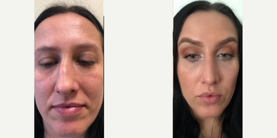 Rhinoplasty before and after photo