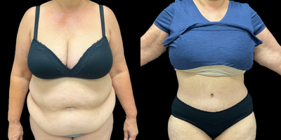 Tummy Tuck before and after photo