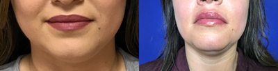 Volbella before and after photo