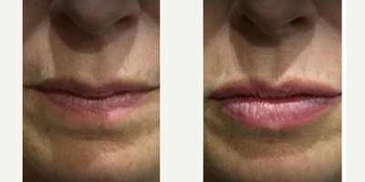 Dermal Fillers before and after photo