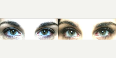 Latisse before and after photo