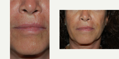 Revision Rhinoplasty before and after photo