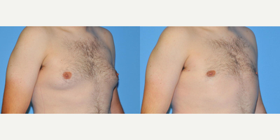 Breast Reduction before and after photo