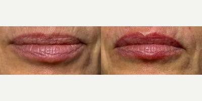 Dermal Fillers before and after photo