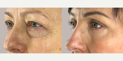 Eyelid Surgery before and after photo