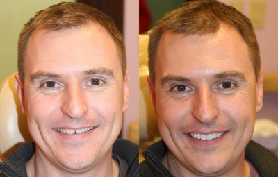 Porcelain Veneers before and after photo