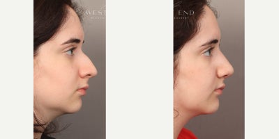 Rhinoplasty before and after photo
