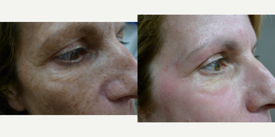 Fraxel Laser before and after photo