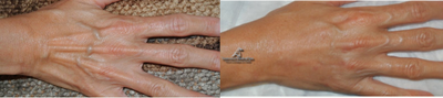 Hand Rejuvenation before and after photo