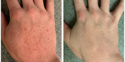 IPL before and after photo