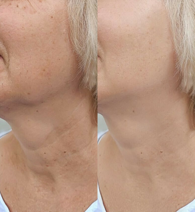Neck Lift before and after photo