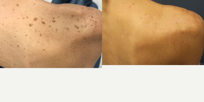 Skin Rejuvenation before and after photo