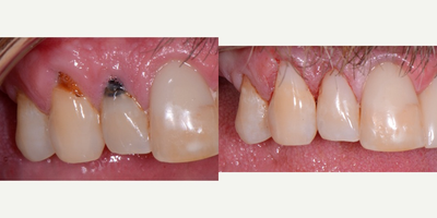 Tooth Repair before and after photo