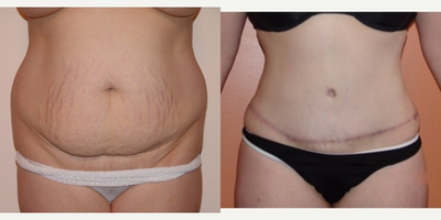 Tummy Tuck before and after photo