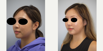 Asian Rhinoplasty before and after photo