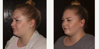 Botox before and after photo