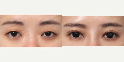 Double Eyelid Surgery before and after photo