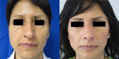 Rhinoplasty before and after photo