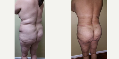 Brazilian Butt Lift before and after photo