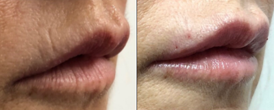Dermal Fillers before and after photo