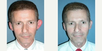 Ear Surgery before and after photo
