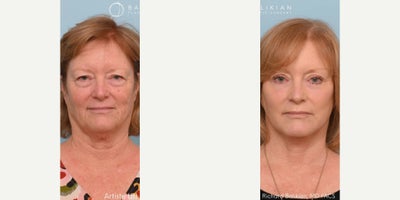 Eyelid Surgery before and after photo