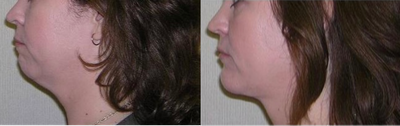 Genioplasty before and after photo