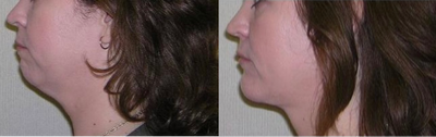 Genioplasty before and after photo