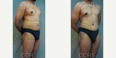 Male Tummy Tuck before and after photo