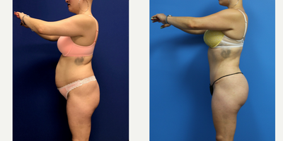 Mommy Makeover before and after photo