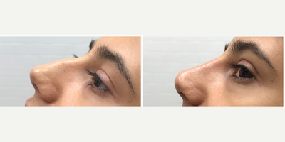 Nonsurgical Nose Job before and after photo