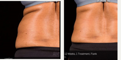 SculpSure before and after photo