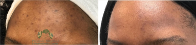 YAG Laser before and after photo