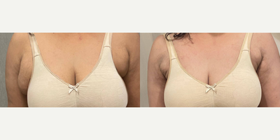 Breast Reduction before and after photo