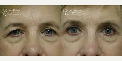 Eyelid Surgery before and after photo