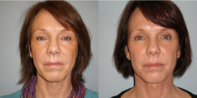 Facelift before and after photo