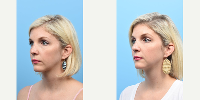Restylane Silk before and after photo