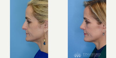 Rhinoplasty before and after photo