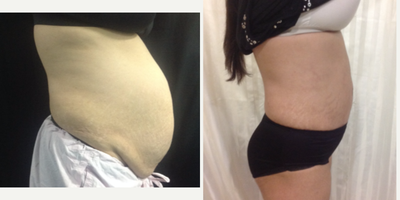Tummy Tuck before and after photo