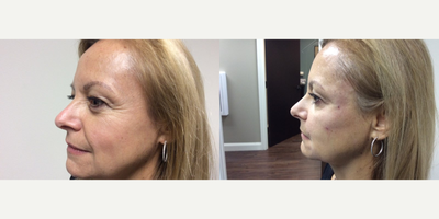 Bellafill before and after photo