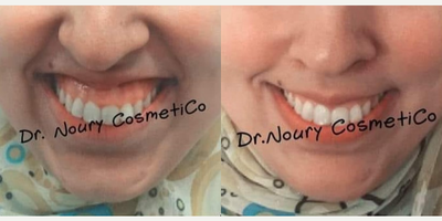 Botox for Gummy Smile before and after photo